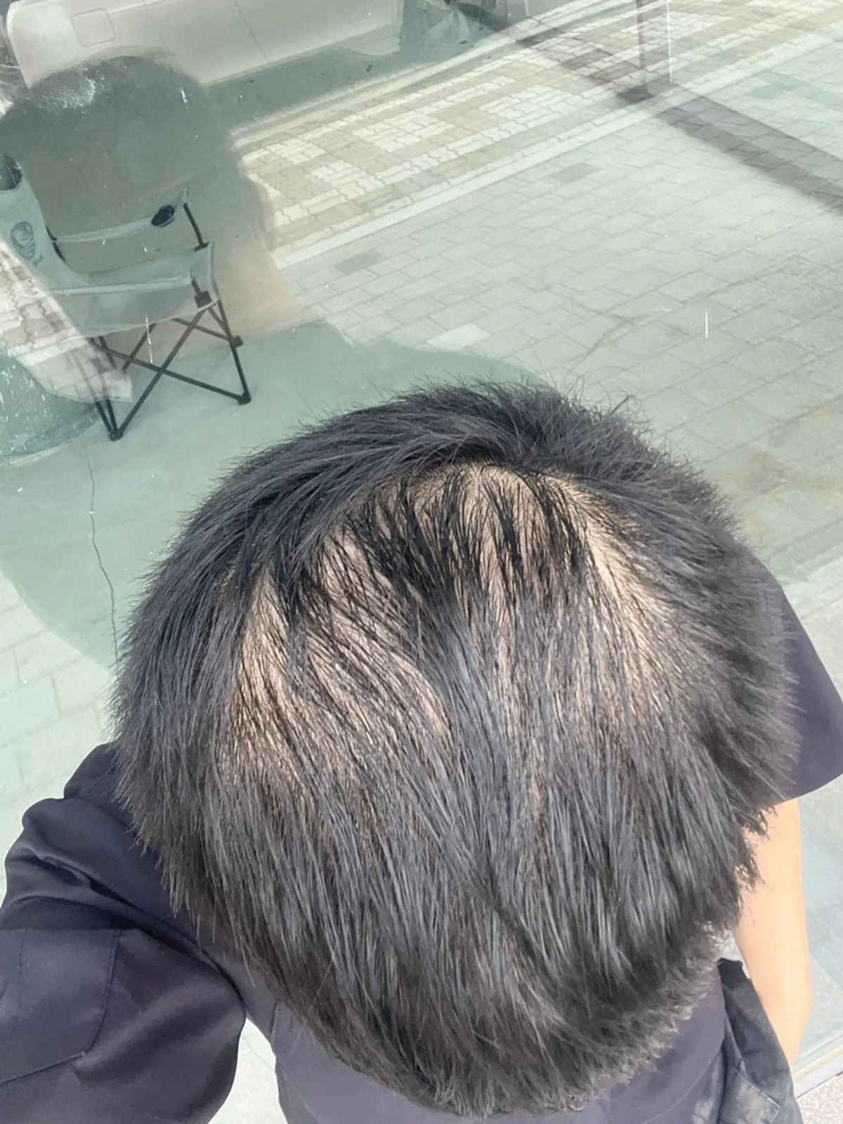 Hình vùng xoáy tóc của trường hợp HLS-001 trước điều trị