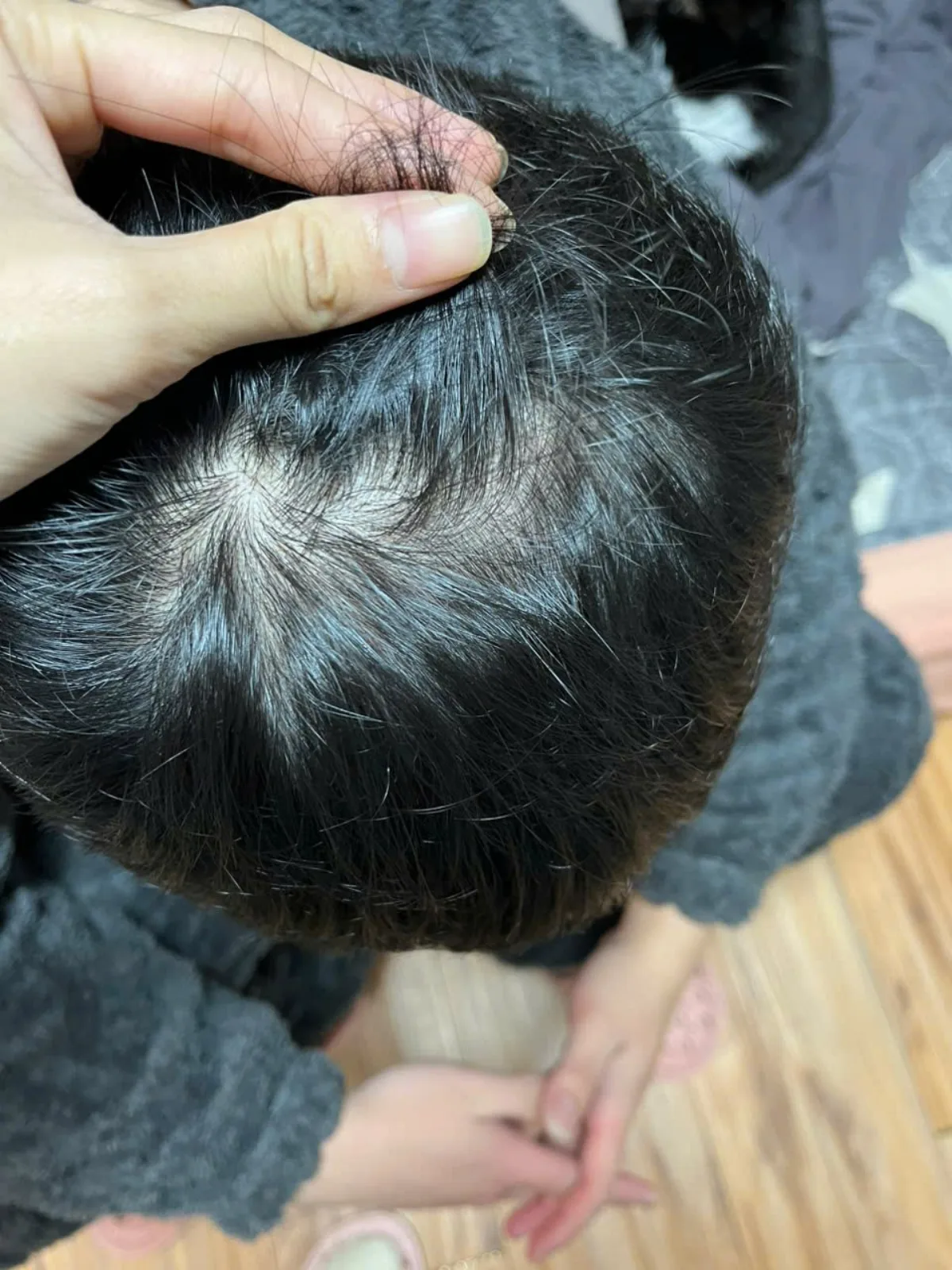 Hình vùng đỉnh đầu ở lần theo dõi cuối đã chọn của trường hợp HLS-001