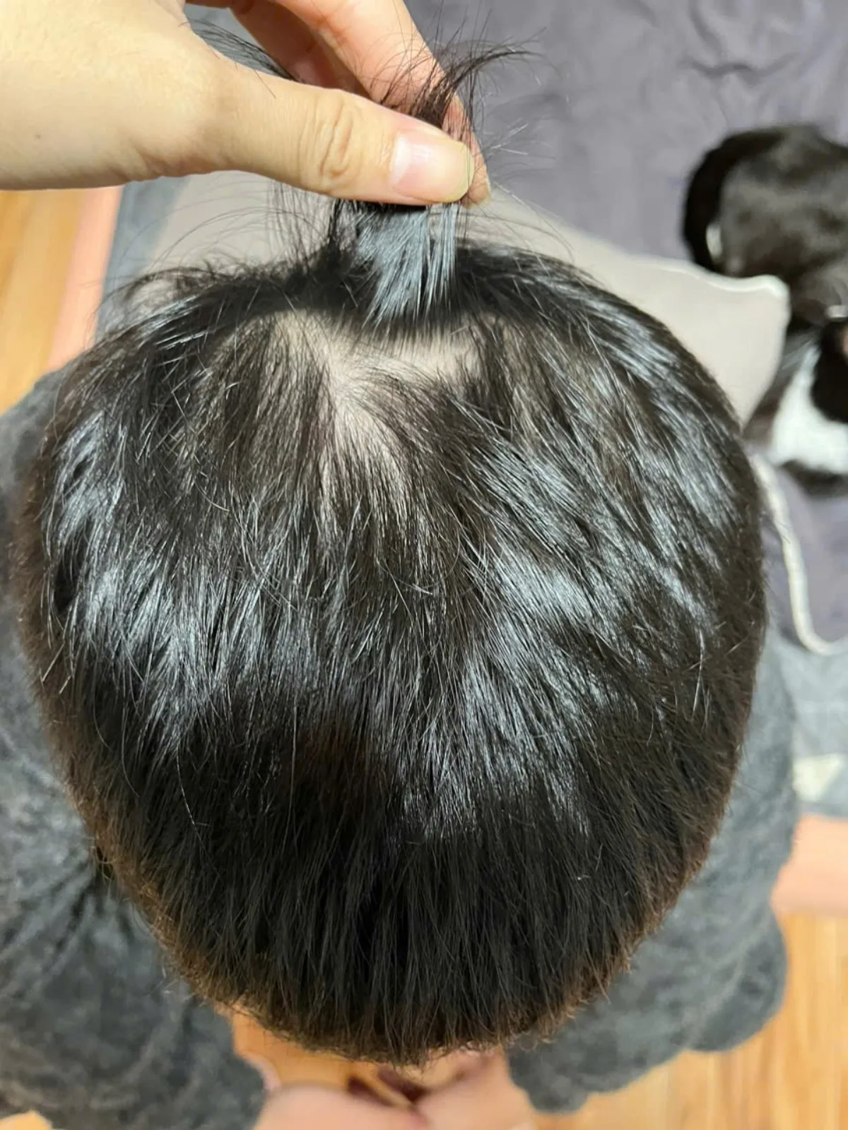 Hình vùng xoáy tóc ở lần theo dõi cuối đã chọn của trường hợp HLS-001