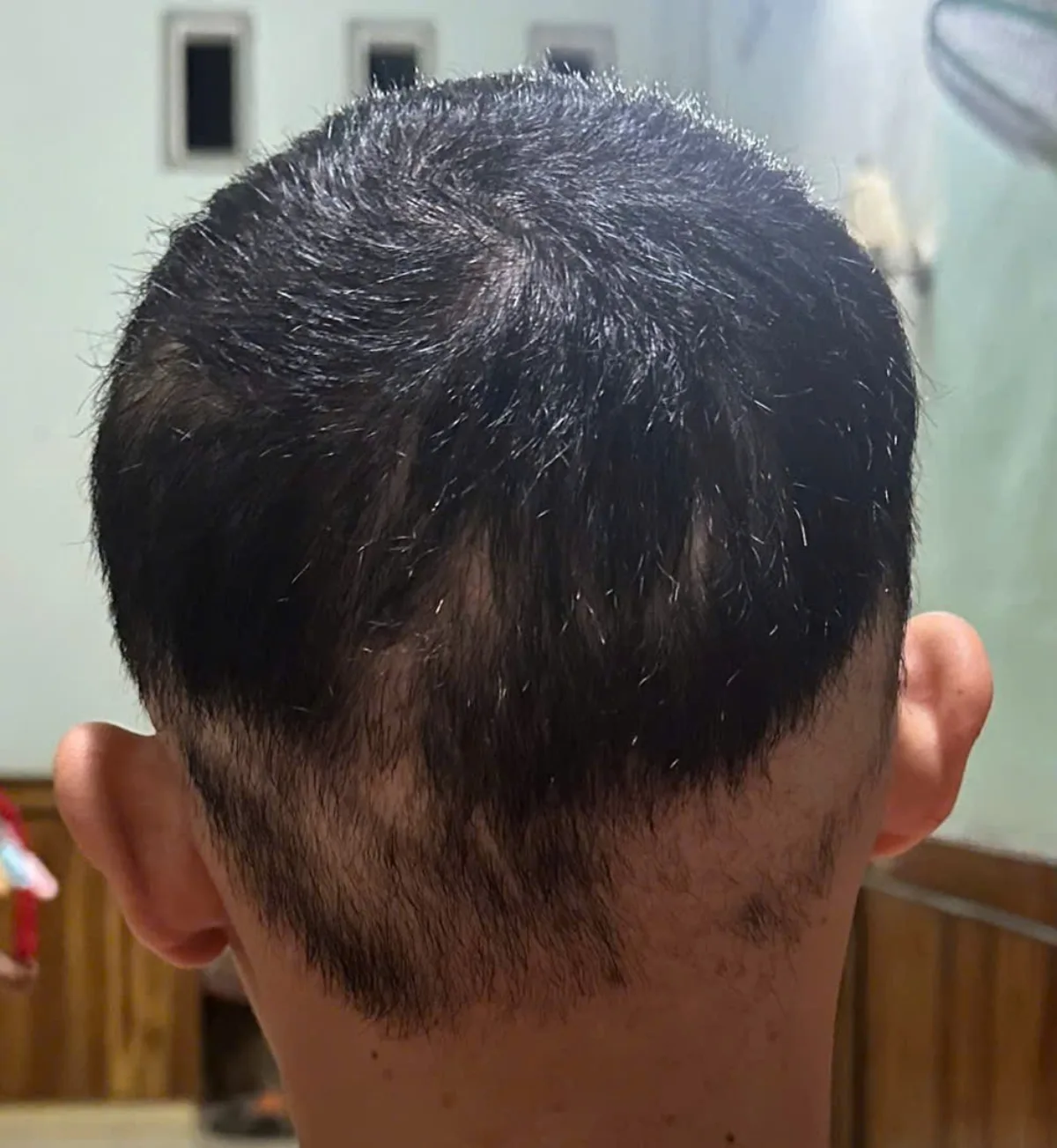 Hình phía sau da đầu ở lần theo dõi đã chọn của trường hợp HLS-004
