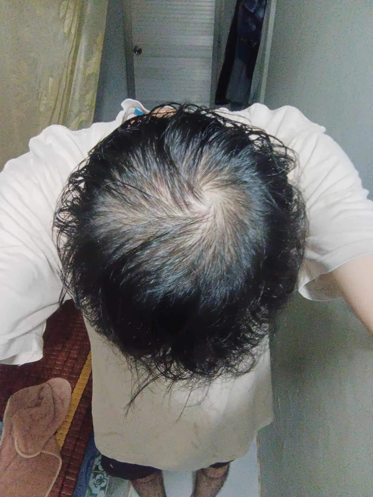 Hình vùng đỉnh đầu của trường hợp HLS-005 trước điều trị