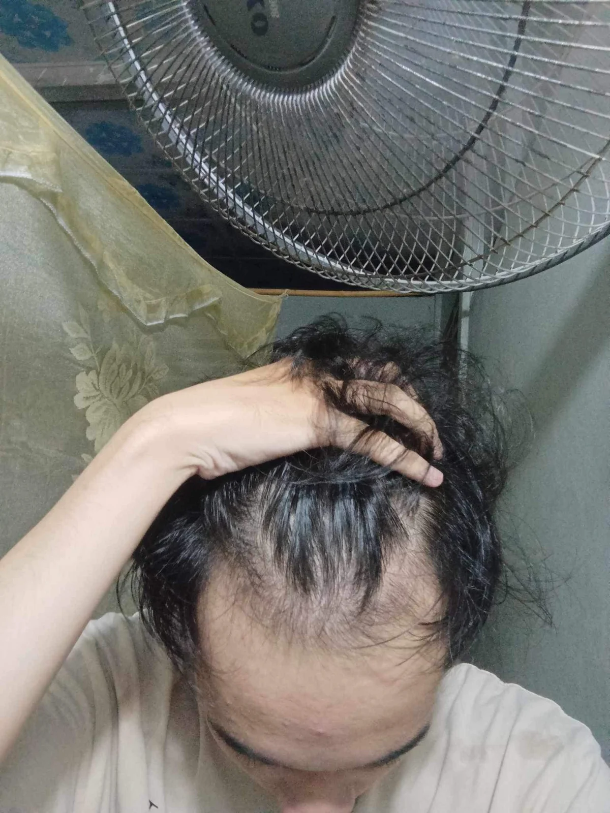 Hình vùng da đầu phía trước của trường hợp HLS-005 trước điều trị