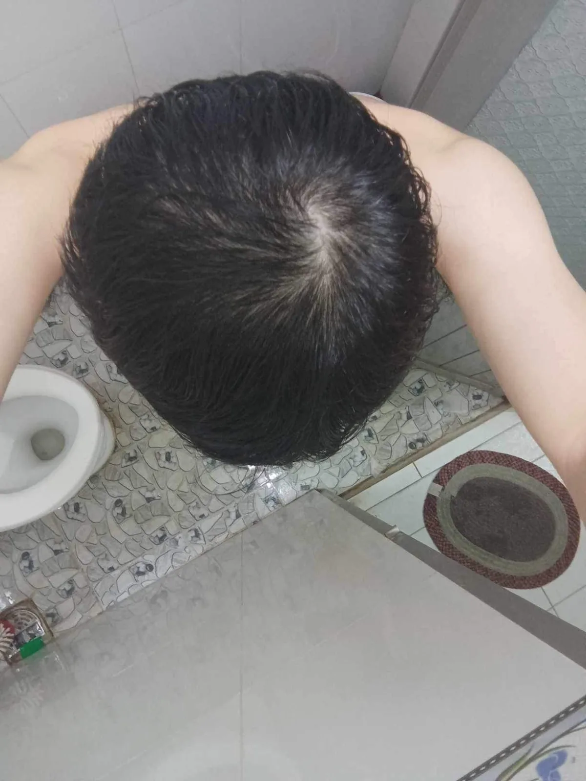 Hình vùng đỉnh đầu của trường hợp HLS-005 ở tháng thứ 3