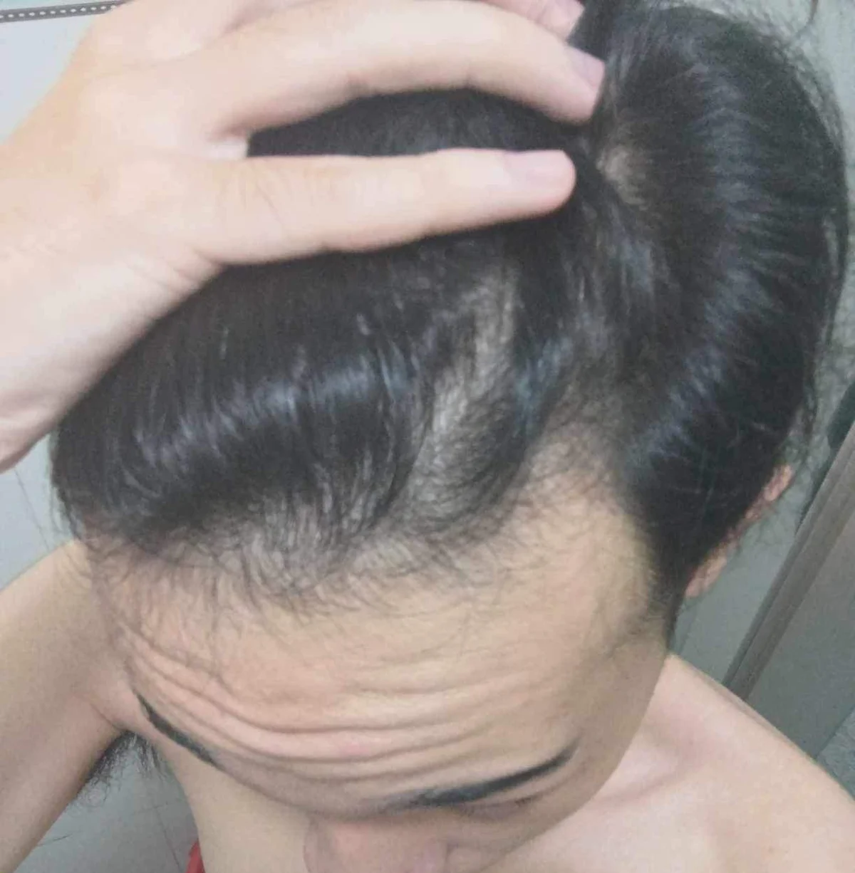 Hình vùng da đầu phía trước của trường hợp HLS-005 ở tháng thứ 3